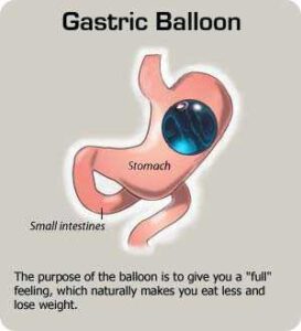 Gastric Balloon