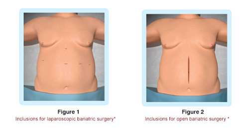 Laparoscopic Appendectomy