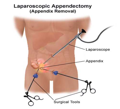 Laparoscopic Surgery in pune