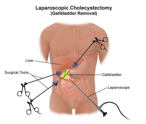 Laparoscopic-Cholecystectomy