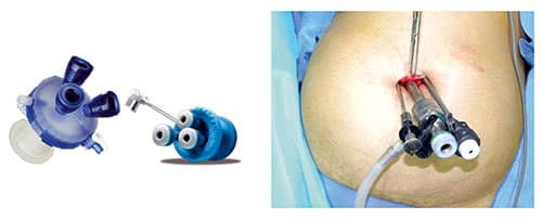 Single-incision-laparoscopic-surgery