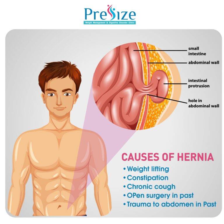 Hernia Treatment