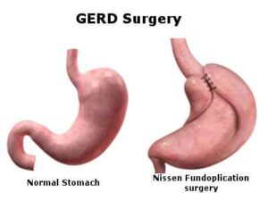 GRED Surgery