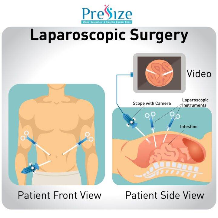 Laparoscopy surgery in pune