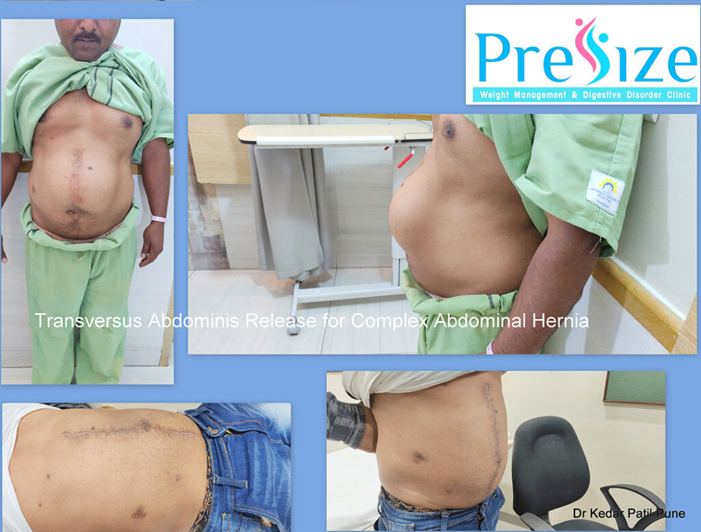 Hernia Surgery In Pune