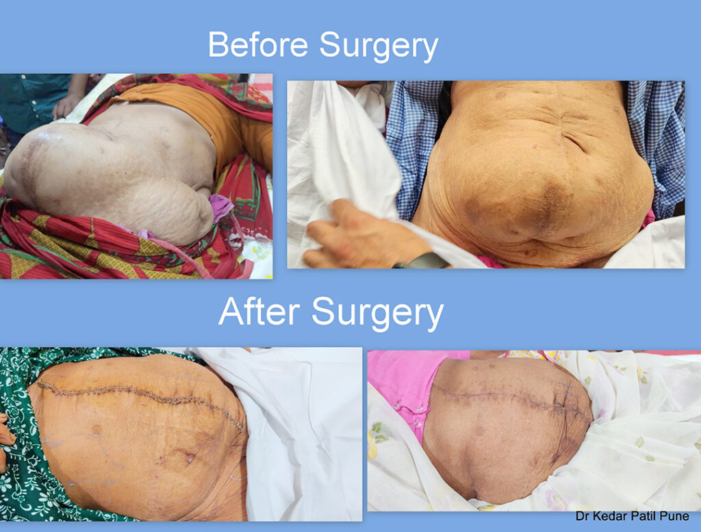 Hernia Surgery