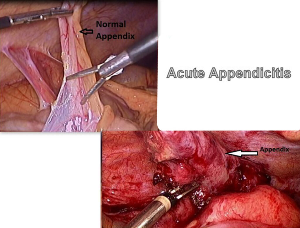 Acute appendicitis