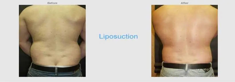 Before and after back view results of male liposuction