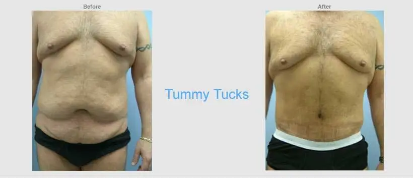 Before and after front view results of male tummy tuck surgery Before and after front view results of male tummy tuck surgery