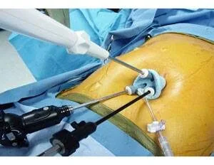 Close-up of laparoscopic surgery instruments inserted into patient’s abdomen