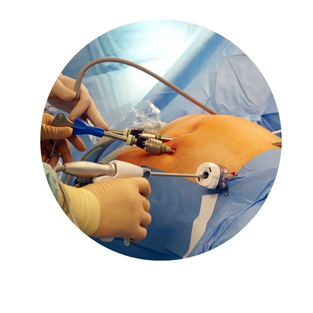 Close up of surgeons performing laparoscopic surgery using specialized instruments inserted through small incisions in the patients abdomen Close-up of surgeons performing laparoscopic surgery using specialized instruments inserted through small incisions in the patient’s abdomen