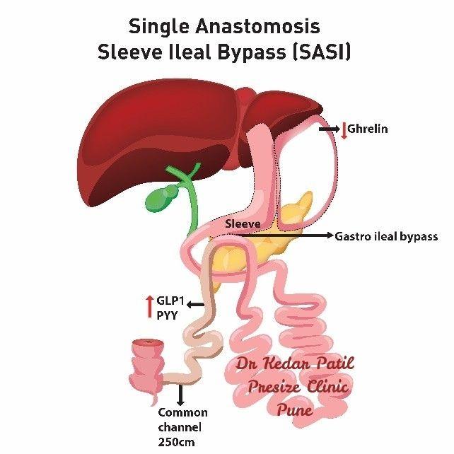 Diagram of Single Anastomosis Sleeve Ileal Bypass (SASI) showing stomach sleeve, gastro-ileal bypass, increased GLP1 and PYY levels, and reduced ghrelin hormone.