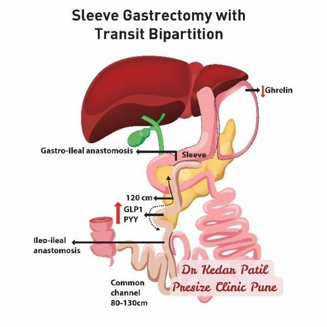 Diagram of Sleeve Gastrectomy with Transit Bipartition featuring gastro-ileal and ileo-ileal anastomosis, sleeve resection, and increased GLP1 and PYY. Common channel length also shown.