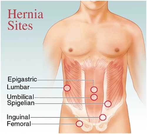 Diagram of human torso showing different hernia sites