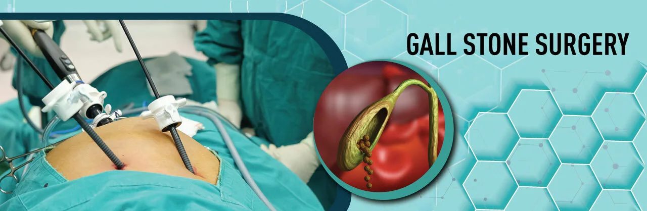 Gallstone surgery banner showing laparoscopic procedure and gallbladder illustration