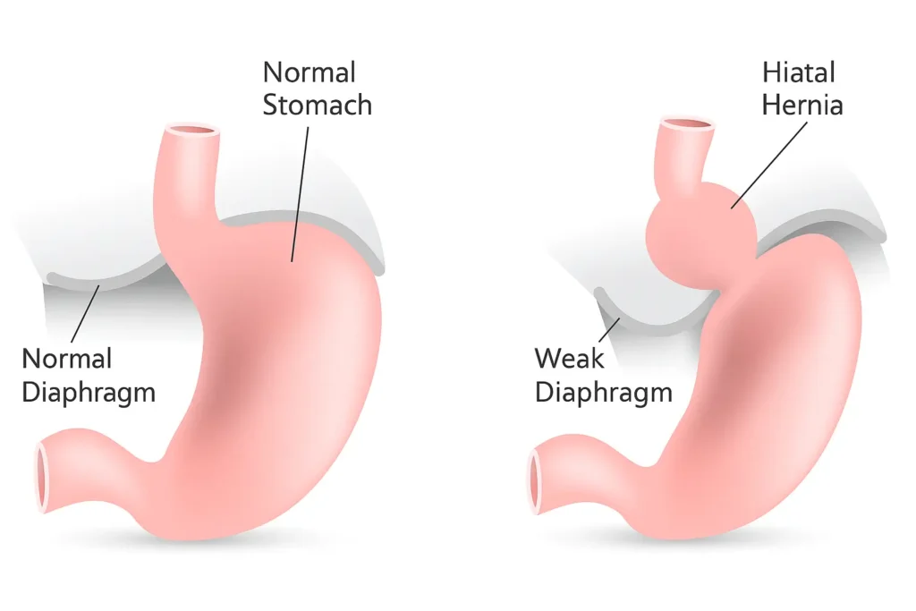Hiatal Hernia