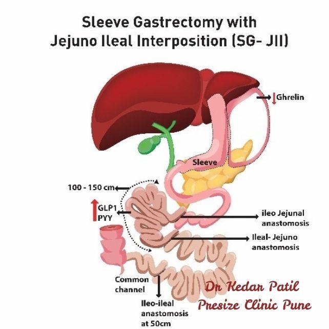 Illustration of Sleeve Gastrectomy with Jejuno Ileal Interposition (SG-JII) showing sleeve resection, ileo-jejunal and ileal-jejunal anastomoses, hormone response (GLP1, PYY), and common channel pathway.