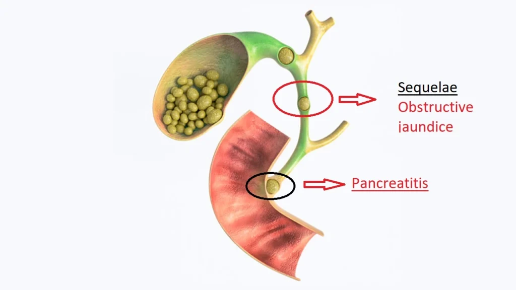 Illustration showing gallstones causing obstructive jaundice and pancreatitis