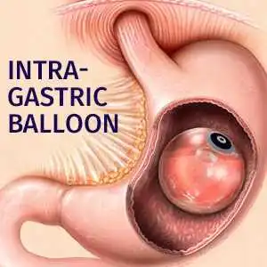 Intragastric balloon inside the stomach for weight loss treatment Intragastric balloon inside the stomach for weight loss treatment