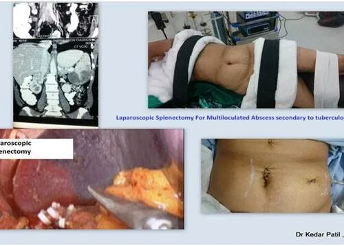 Laparoscopic splenectomy procedure images and patient recovery
