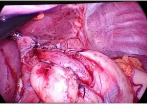 Laparoscopic surgical view of internal organs during procedure