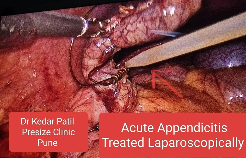 Laparoscopic view of acute appendicitis being treated surgically
