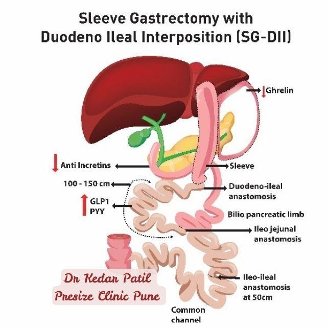 Medical illustration of Sleeve Gastrectomy with Duodeno Ileal Interposition (SG-DII) showing stomach sleeve, duodeno-ileal anastomosis, reduced anti-incretins, and enhanced GLP1, PYY.