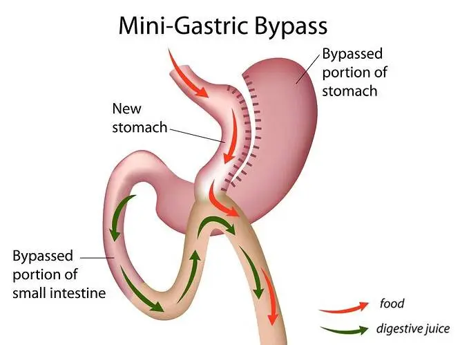 Medical illustration of mini-gastric bypass showing new stomach, bypassed portion of stomach, and rerouted small intestine