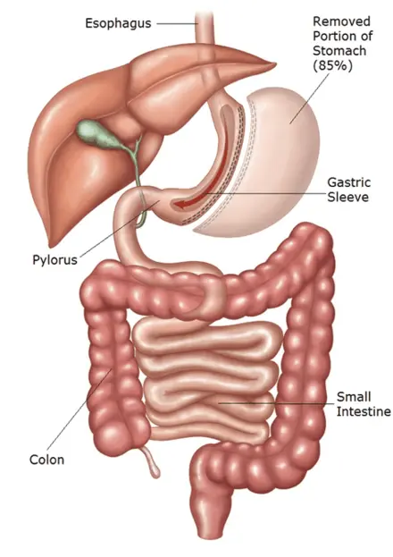 Medical illustration of the digestive system showing gastric sleeve surgery with 85 of the stomach removed Medical illustration of the digestive system showing gastric sleeve surgery with 85% of the stomach removed