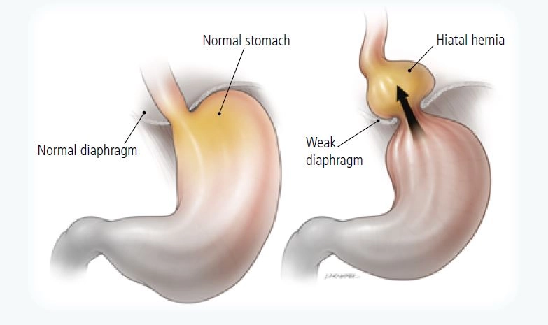 Medical illustration showing normal stomach and hiatal hernia comparison