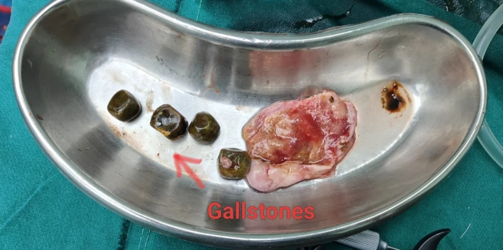 Surgical tray containing removed gallstones and gallbladder