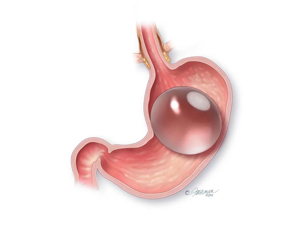 intragastric balloon placed inside the stomach for weight loss treatment